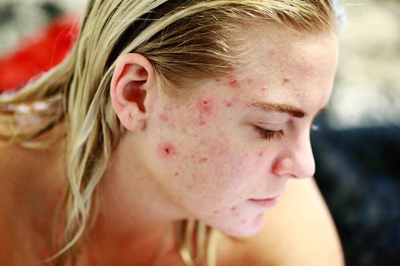 ontdek effectieve tips en behandelmethoden voor acne. leer hoe je je huid gezond en stralend kunt houden met onze uitgebreide gids vol advies en productaanbevelingen.